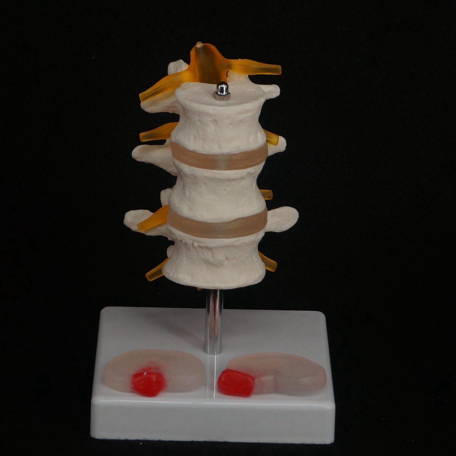 Human Three Lumbar Lesions Intervertebral Disc Skeleton Spine Medical Model - KiwisLove
