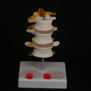Human Three Lumbar Lesions Intervertebral Disc Skeleton Spine Medical Model - KiwisLove