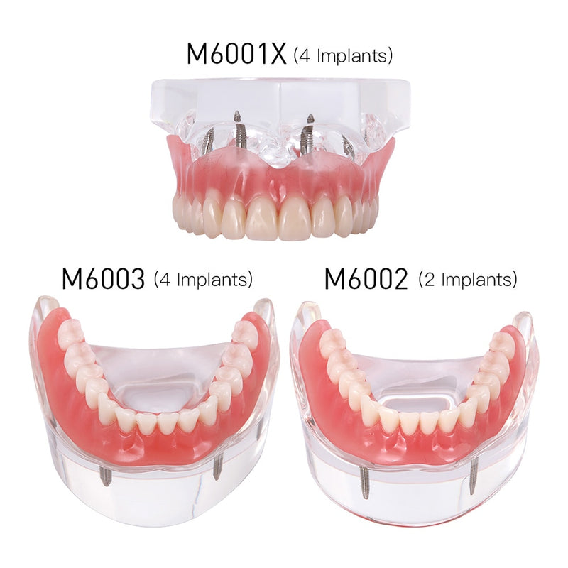 Dental Overdenture Teeth Teaching Model Removable Interior Mandibular With Implant - KiwisLove