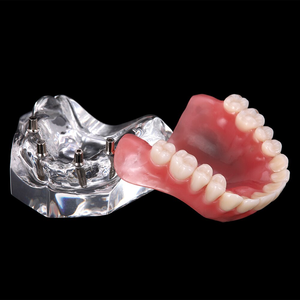 Dental Overdenture Teeth Model Removable Interior Mandibular Lower  Mandibular With Implant For Tooth Teaching Study - KiwisLove