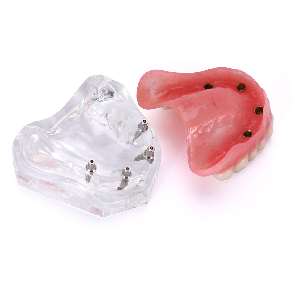Dental Overdenture Teeth Model Removable Interior Mandibular Lower  Mandibular With Implant For Tooth Teaching Study - KiwisLove