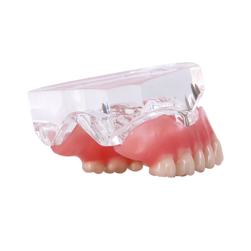 Dental Overdenture Teeth Teaching Model Removable Interior Mandibular With Implant - KiwisLove