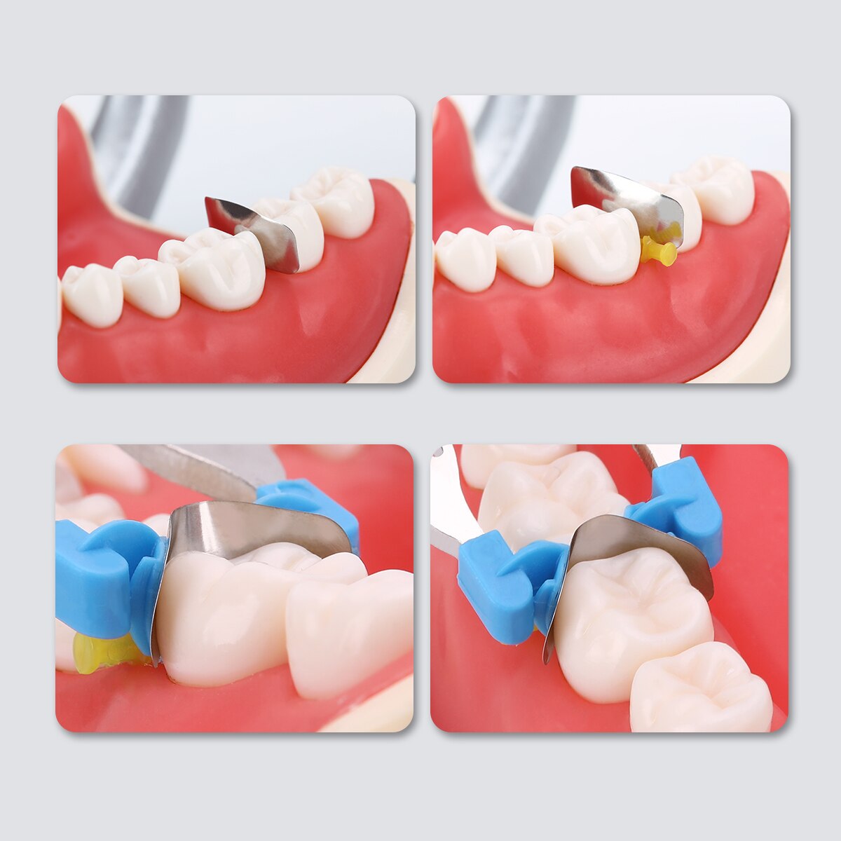 Dental Matrix Sectional Contoured Metal Refill  Full Teeth Replacement Universal Kit With Spring Clipse - KiwisLove