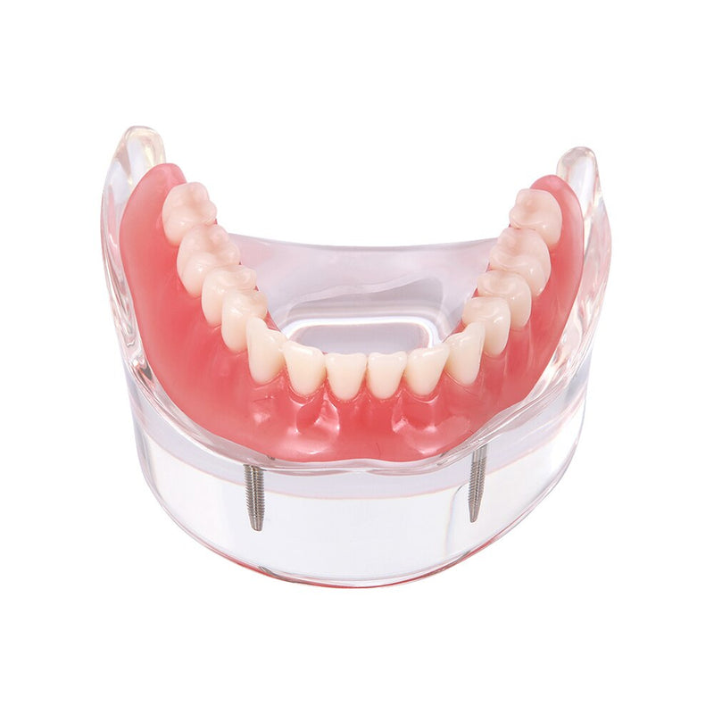Dental Overdenture Teeth Teaching Model Removable Interior Mandibular With Implant - KiwisLove