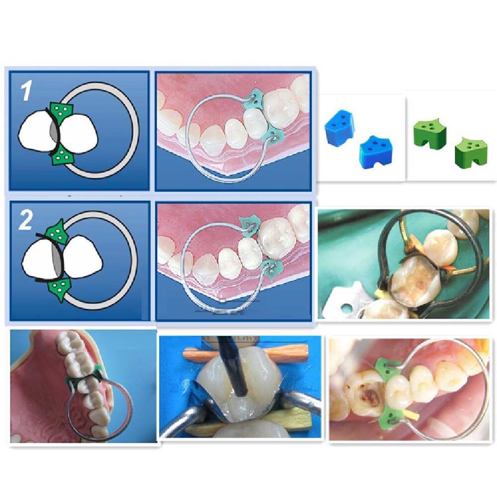 Azdent Dental Matrix Sectional Contoured 40 Pcs Silicone Add-On Wedges - KiwisLove