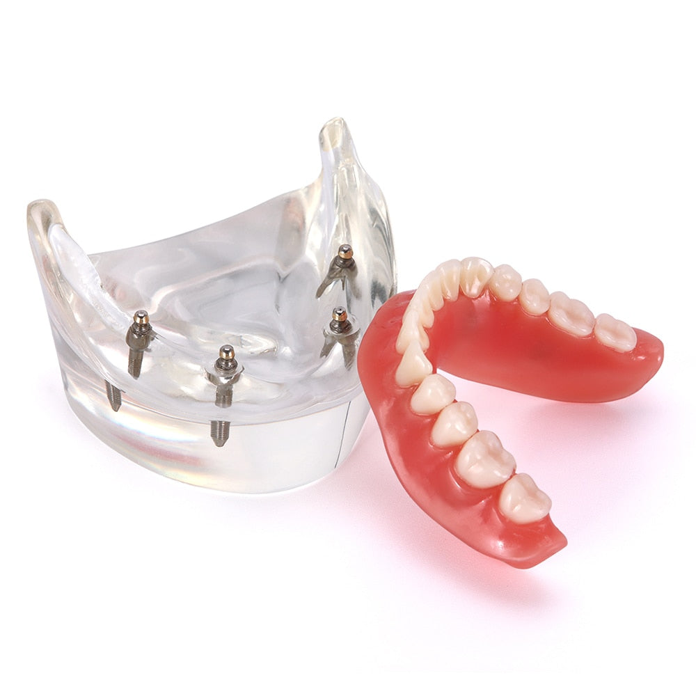 Dental Overdenture Teeth Teaching Model Removable Interior Mandibular With Implant - KiwisLove