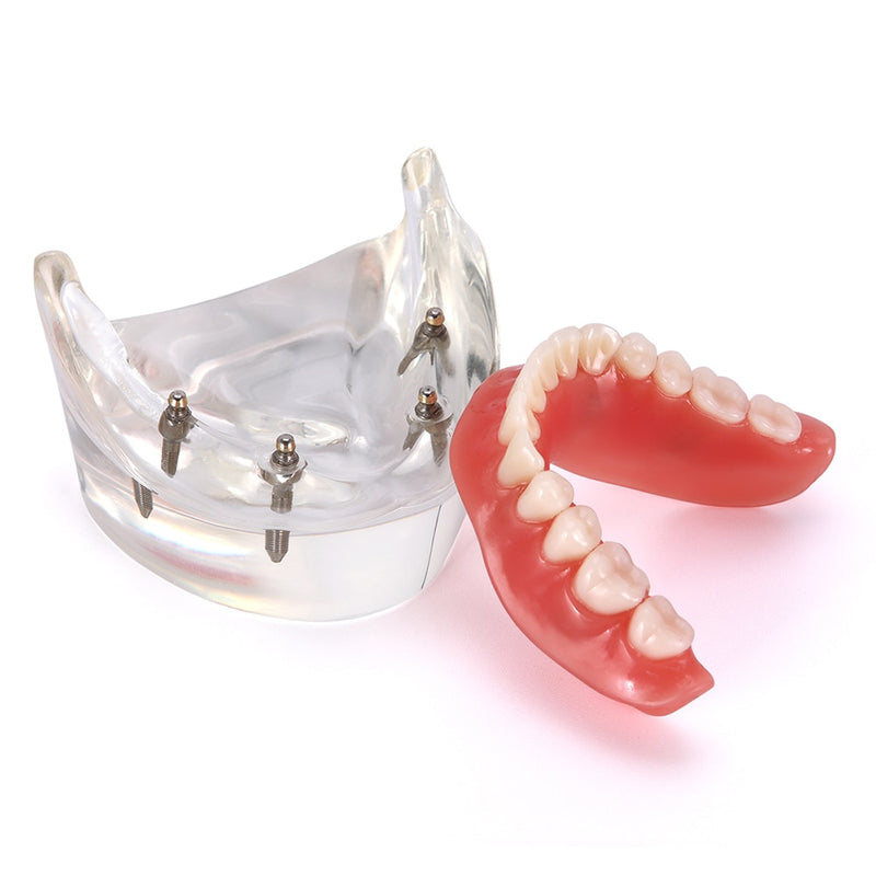 Dental Overdenture Teeth Teaching Model Removable Interior Mandibular With Implant - KiwisLove