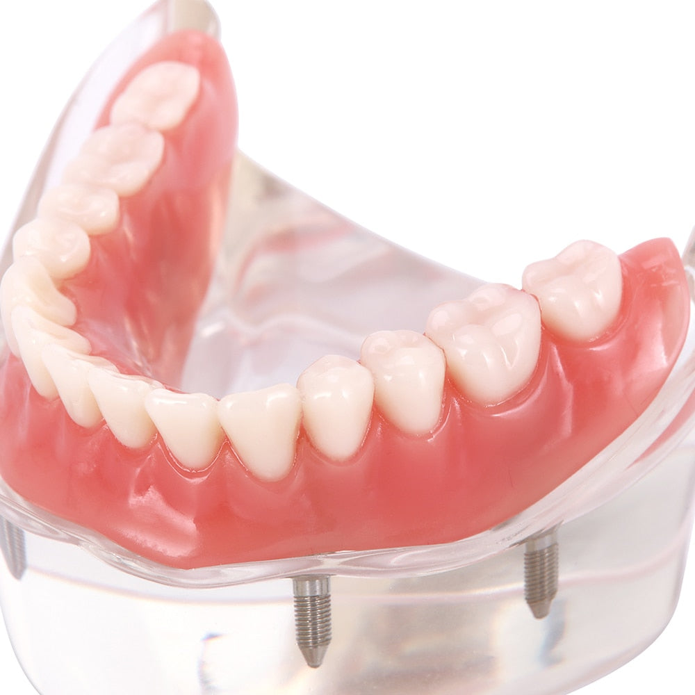 Dental Overdenture Teeth Teaching Model Removable Interior Mandibular With Implant - KiwisLove