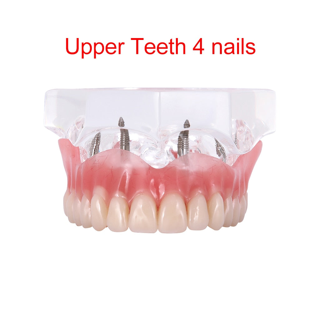 Dental Overdenture Teeth Model Removable Interior Mandibular Lower  Mandibular With Implant For Tooth Teaching Study - KiwisLove