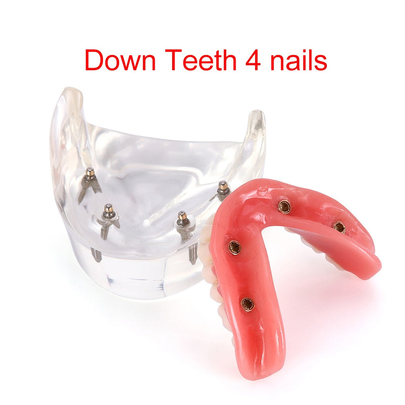 Dental Overdenture Teeth Model Removable Interior Mandibular Lower  Mandibular With Implant For Tooth Teaching Study - KiwisLove