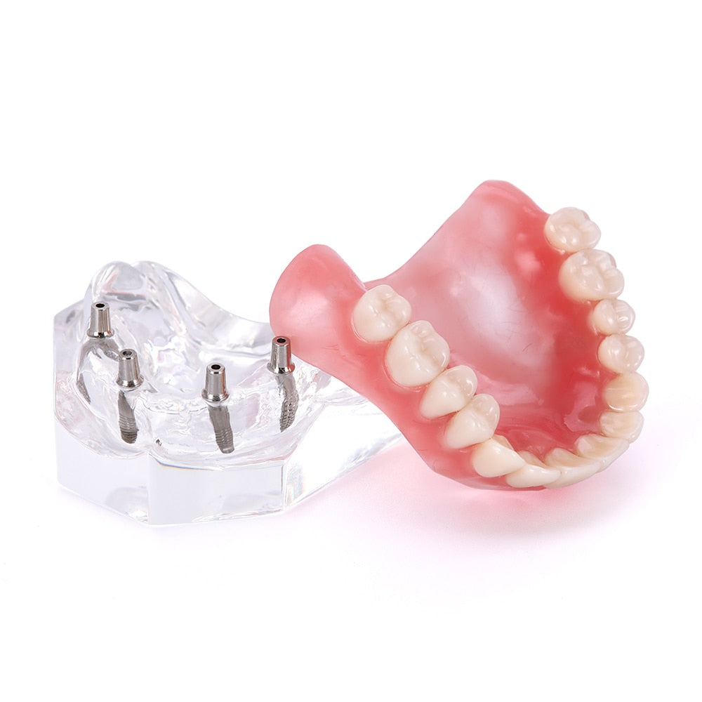Dental Overdenture Teeth Model Removable Interior Mandibular Lower  Mandibular With Implant For Tooth Teaching Study - KiwisLove