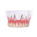 Dental Overdenture Teeth Teaching Model Removable Interior Mandibular With Implant - KiwisLove