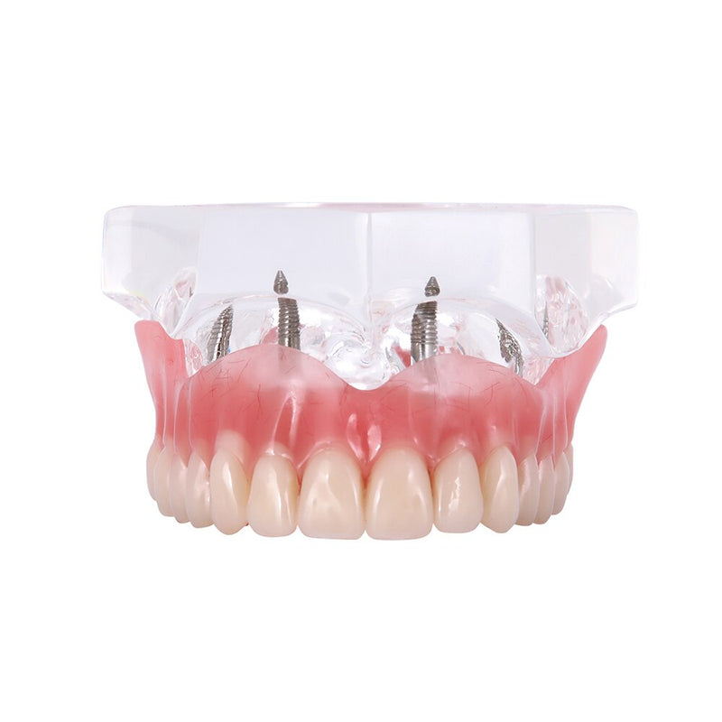 Dental Overdenture Teeth Teaching Model Removable Interior Mandibular With Implant - KiwisLove