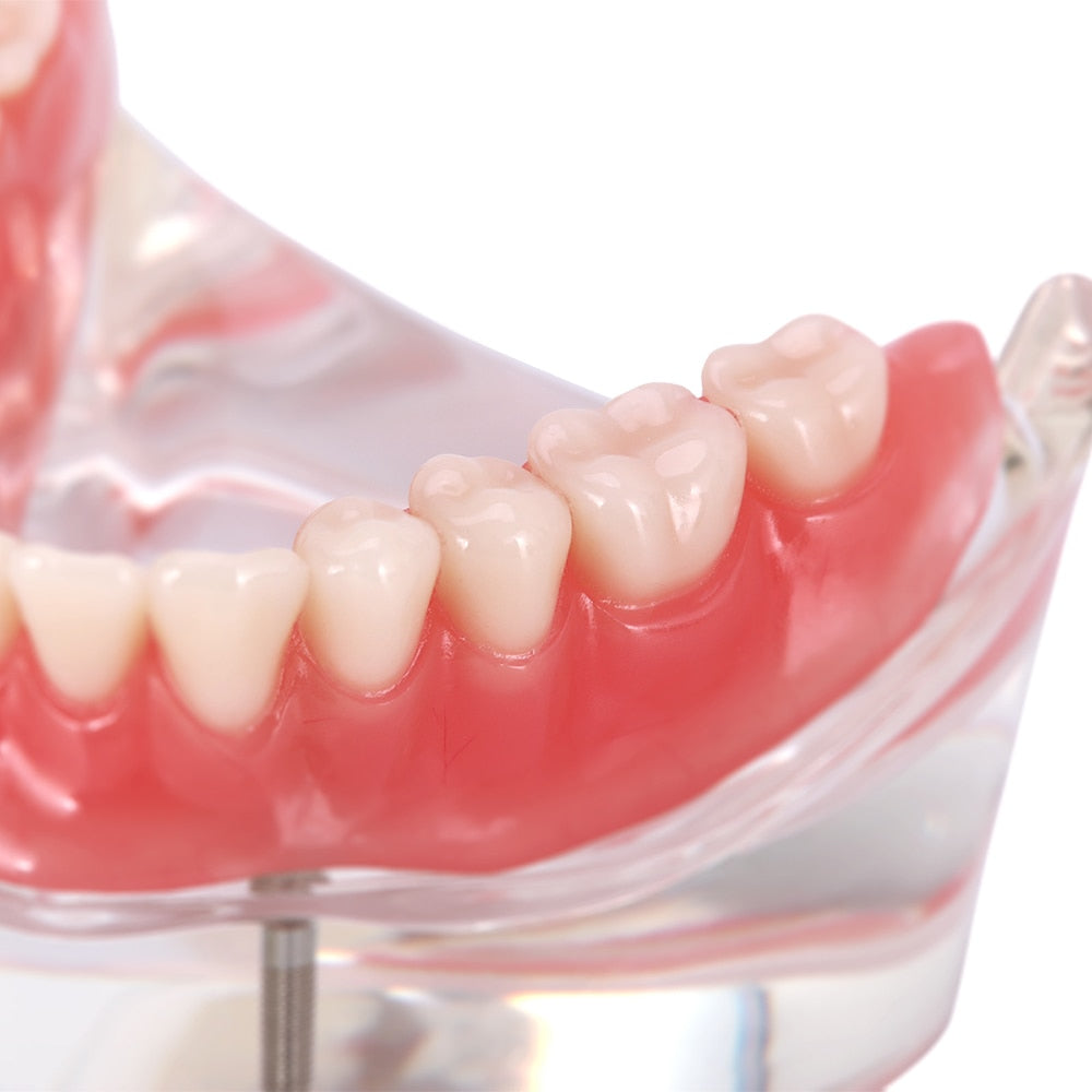 Dental Overdenture Teeth Teaching Model Removable Interior Mandibular With Implant - KiwisLove