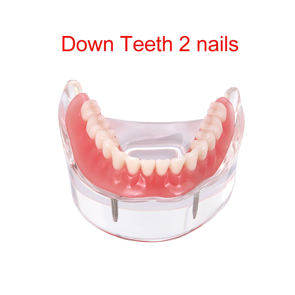 Dental Overdenture Teeth Model Removable Interior Mandibular Lower  Mandibular With Implant For Tooth Teaching Study - KiwisLove