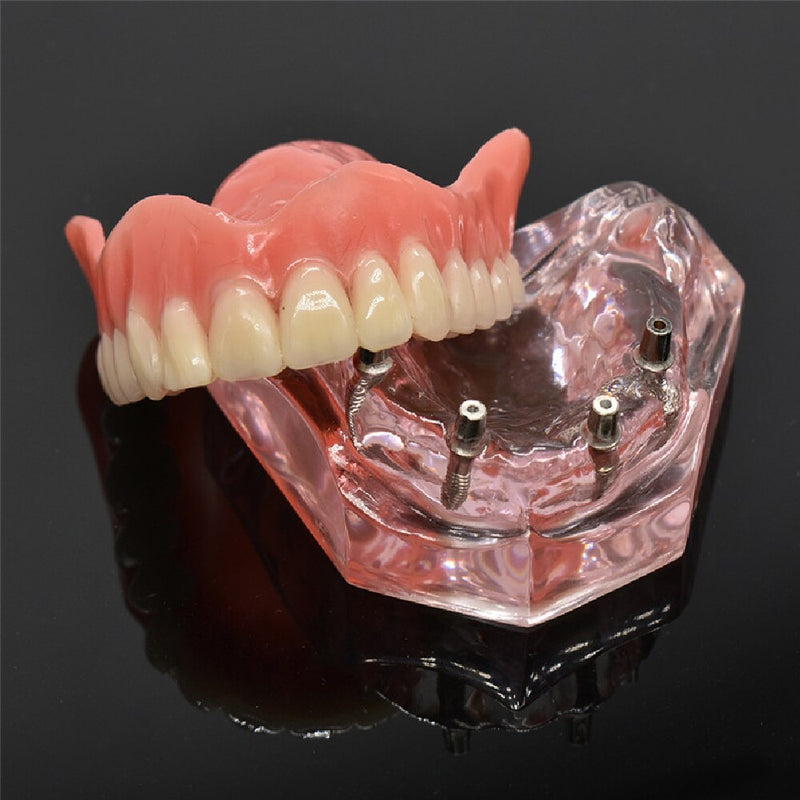 Dental Overdenture Teeth Model Removable Interior Mandibular Lower  Mandibular With Implant For Tooth Teaching Study - KiwisLove