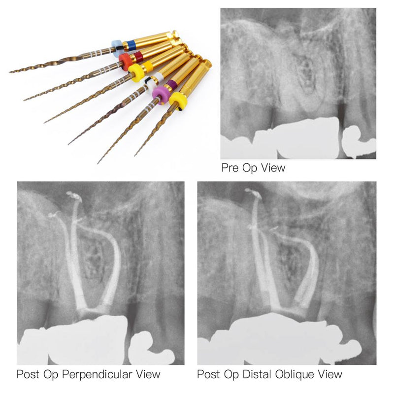 1Pack Dental Endodontic Gold Taper NITI Rotary Files Engine Use Expansion  25mm,SX-F3 - KiwisLove