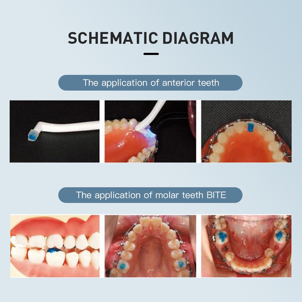 Dental Orthodontic Adhesive Light Cure  Blue Glue Kit - KiwisLove