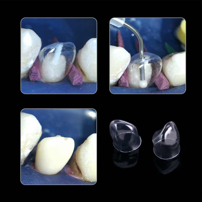 Anterior Transparent Crowns Dental Temporary  Adult Braces - KiwisLove