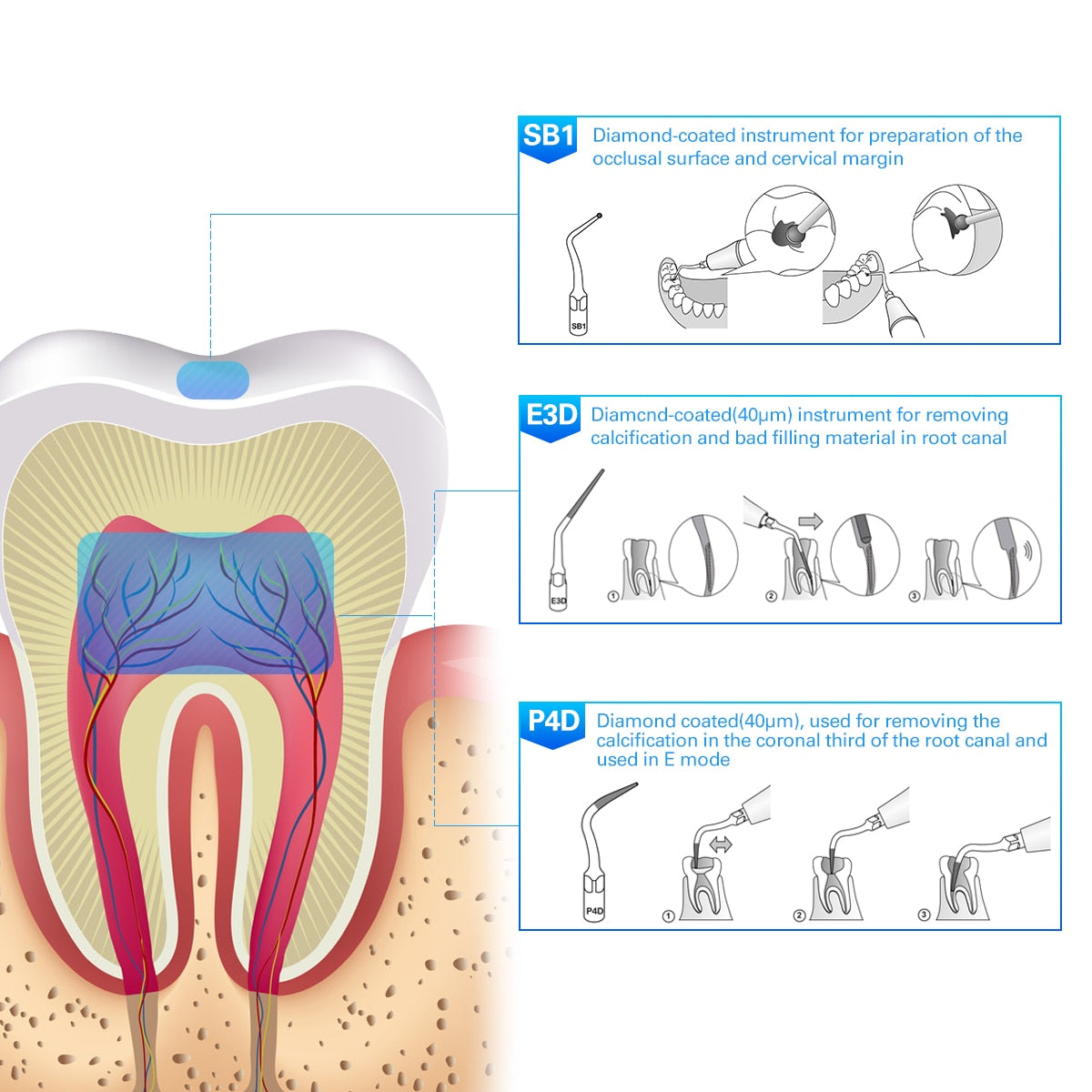 1PC  Dental Ultrasonic Scaler Tip Scaling Periodontics Endodontics Fit For EMS Woodpecker Ultrasonic Scaler Handpiece - KiwisLove