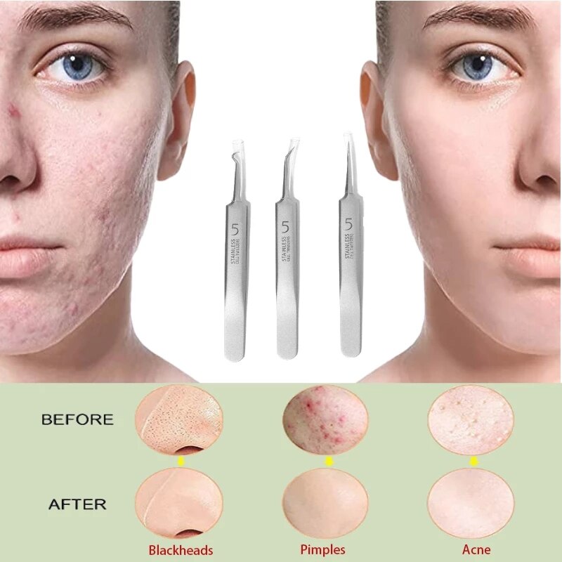 German Ultra-fine No. 5 Cell Pimples Blackhead Clip Tweezers Beauty Salon Special Scraping &amp; Closing Artifact Acne Needle Tool - KiwisLove