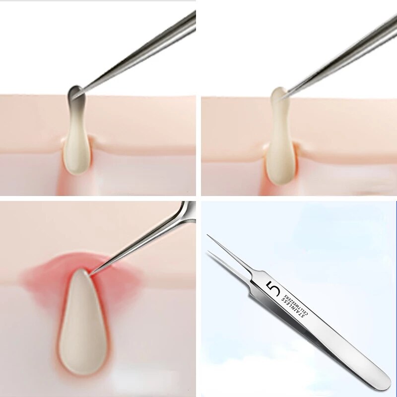 German Ultra-fine No. 5 Cell Pimples Blackhead Clip Tweezers Beauty Salon Special Scraping &amp; Closing Artifact Acne Needle Tool - KiwisLove