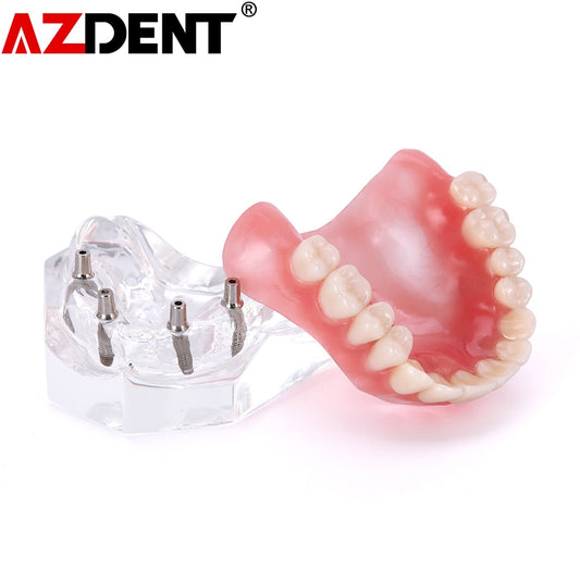 Dental Overdenture Teeth Teaching Model Removable Interior Mandibular With Implant - KiwisLove