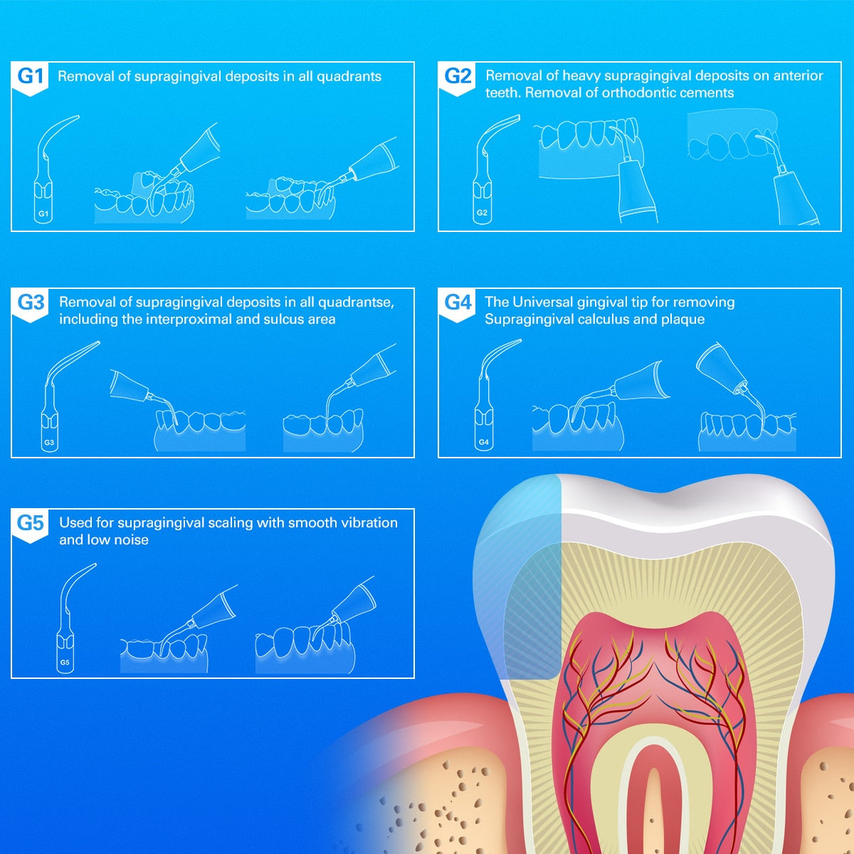 5pcs/Pack Dental Ultrasonic Scaler Tip Scaling Periodontics Endodontics Fit For EMS Woodpecker G1 G2 G3 - KiwisLove