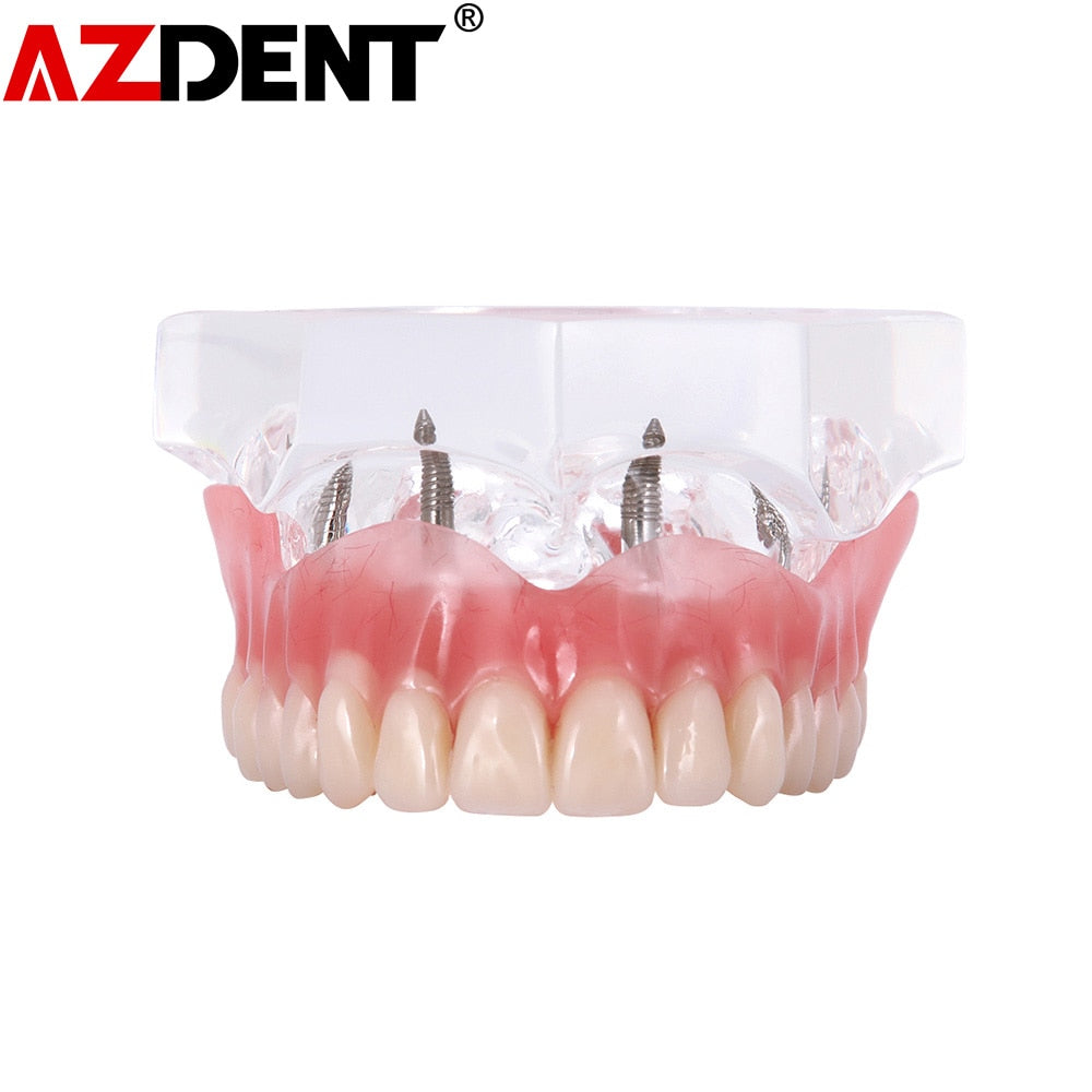 Dental Overdenture Teeth Model Removable Interior Mandibular Lower  Mandibular With Implant For Tooth Teaching Study - KiwisLove