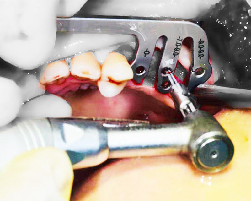 Dental Implant Guide Set Oral Planting Locator Positioning - KiwisLove