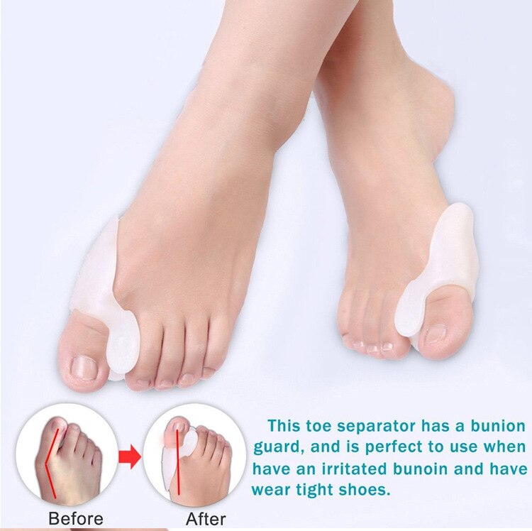 10 pcs hallux valgus orthodontic kit overlapping toe separator thumb care - KiwisLove