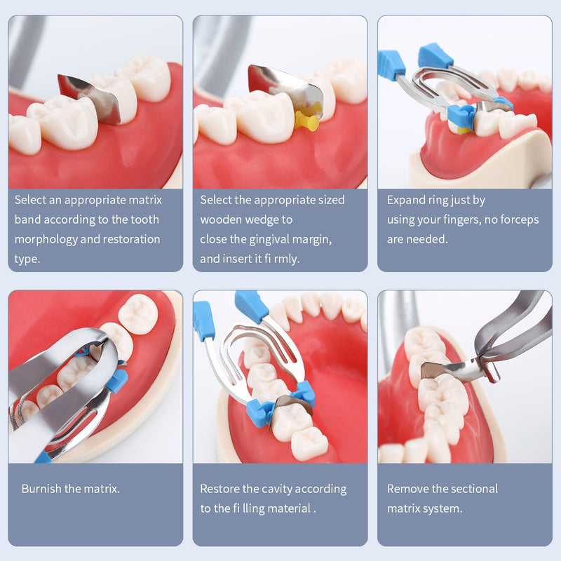 AZDENT Dental Matrix Sectional Contoured Matrices Clamps Wedges - KiwisLove