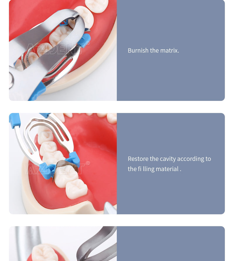 AZDENT Dental Matrix Sectional Contoured Matrices Clamps Wedges - KiwisLove