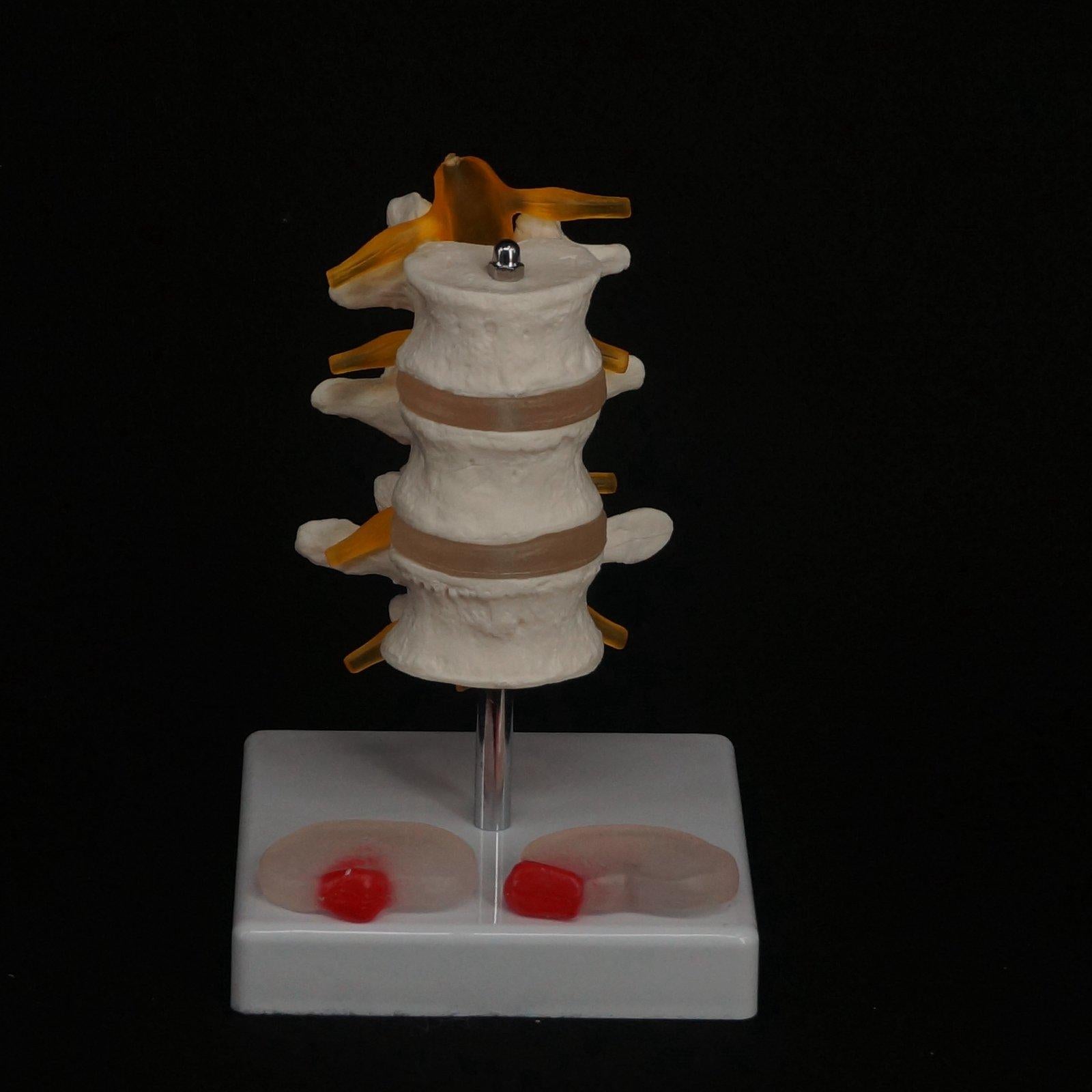 Human Three Lumbar Lesions Intervertebral Disc Skeleton Spine Medical Model - KiwisLove