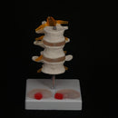 Human Three Lumbar Lesions Intervertebral Disc Skeleton Spine Medical Model - KiwisLove
