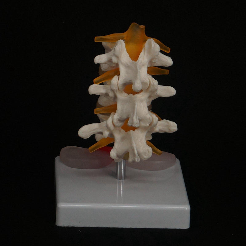 Human Three Lumbar Lesions Intervertebral Disc Skeleton Spine Medical Model - KiwisLove