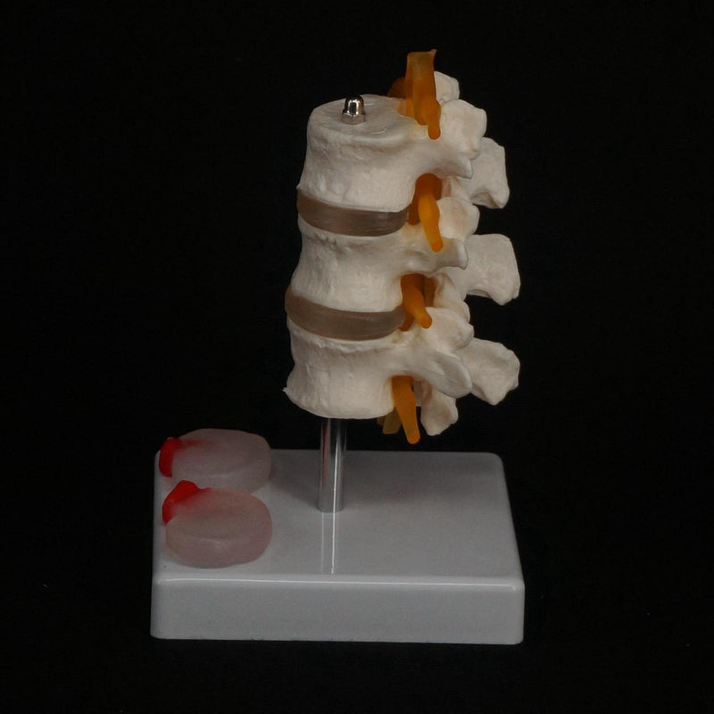 Human Three Lumbar Lesions Intervertebral Disc Skeleton Spine Medical Model - KiwisLove